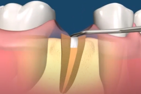 Восстановление разрушенного зуба коронкой