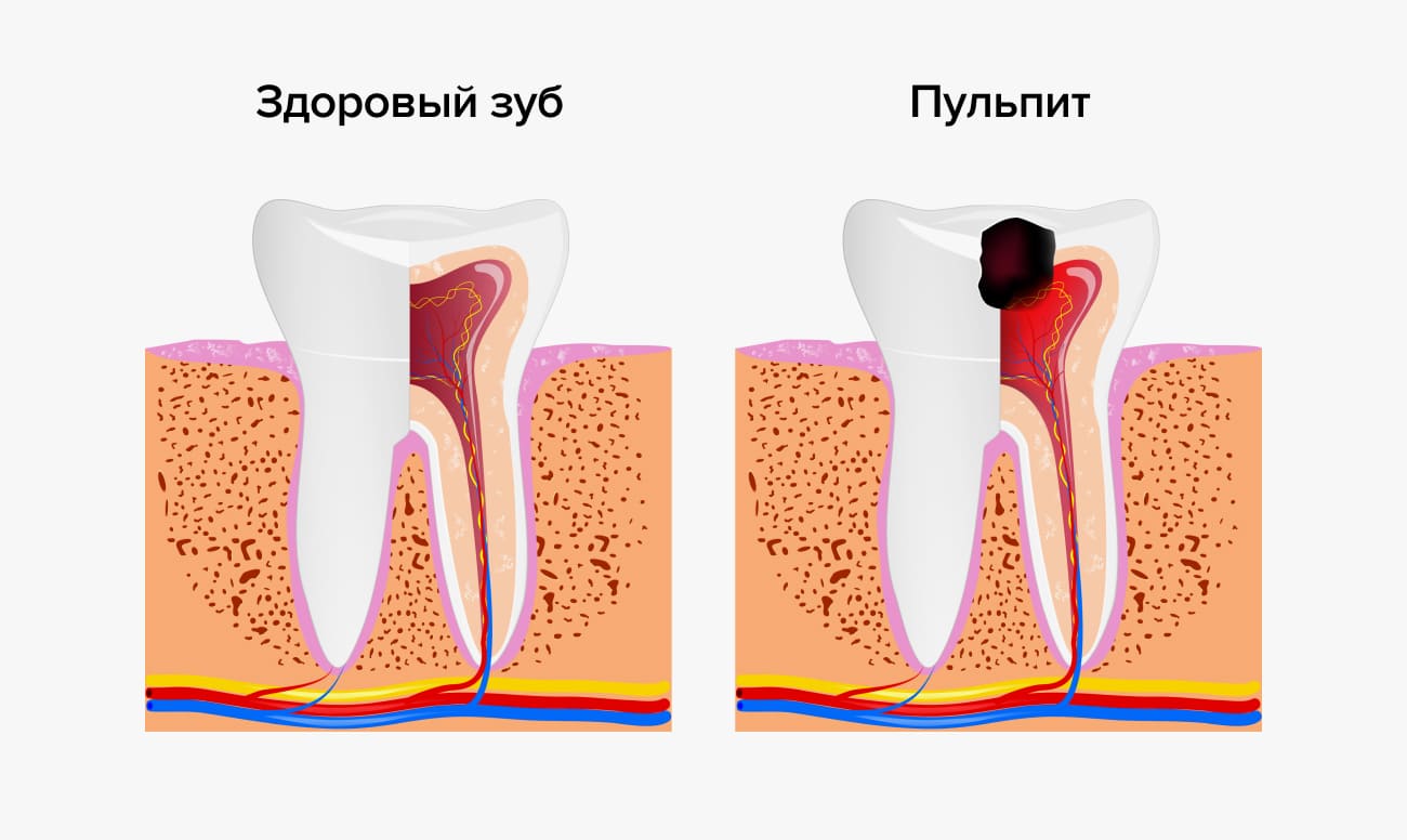 Здоровый зуб и пульпит в картинках