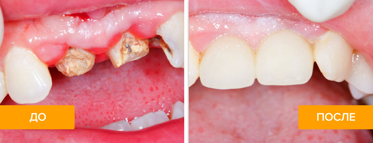 Фото до и после установки коронок на передние зубы