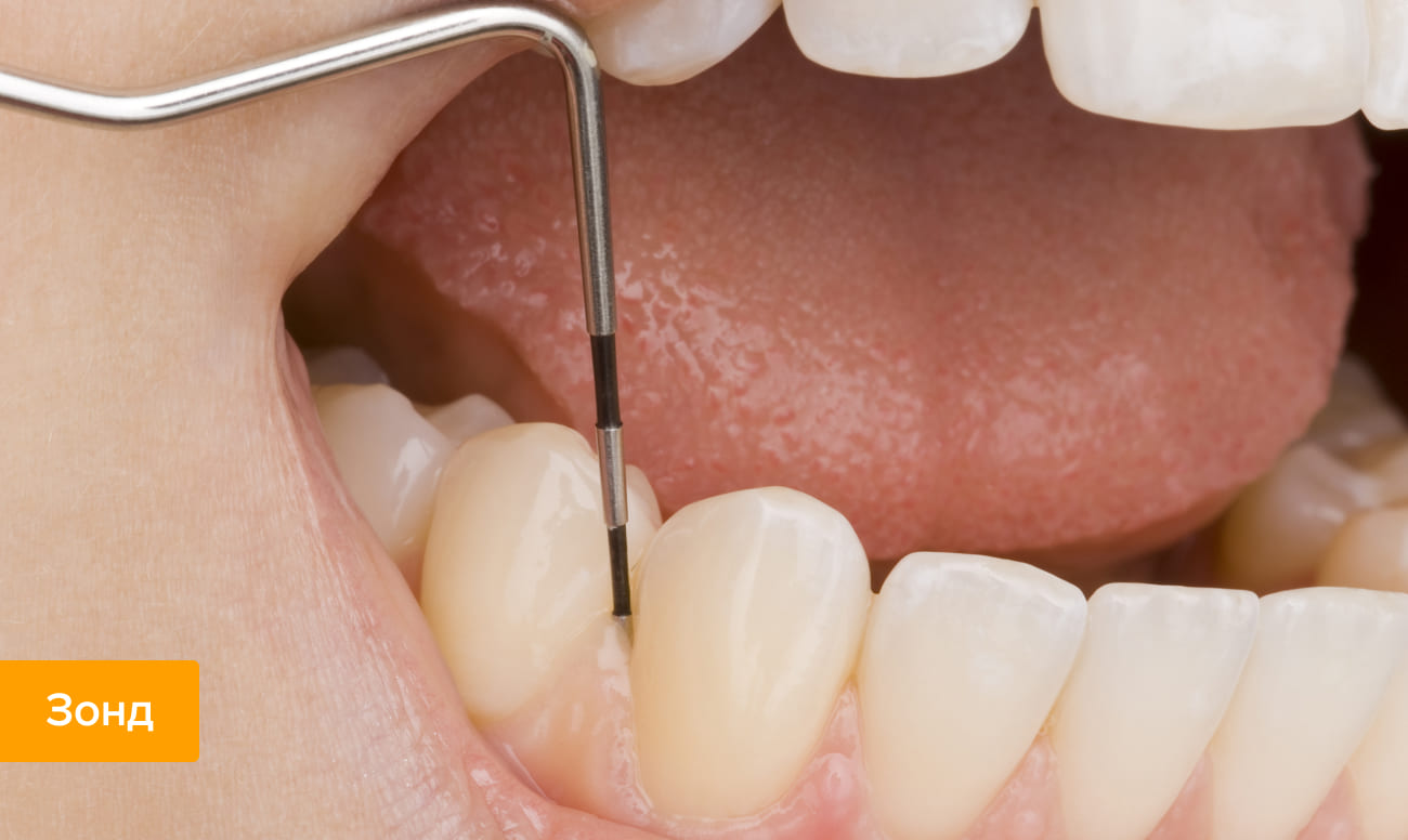 Фото исследования зубных каналов с помощью стоматологического зонда