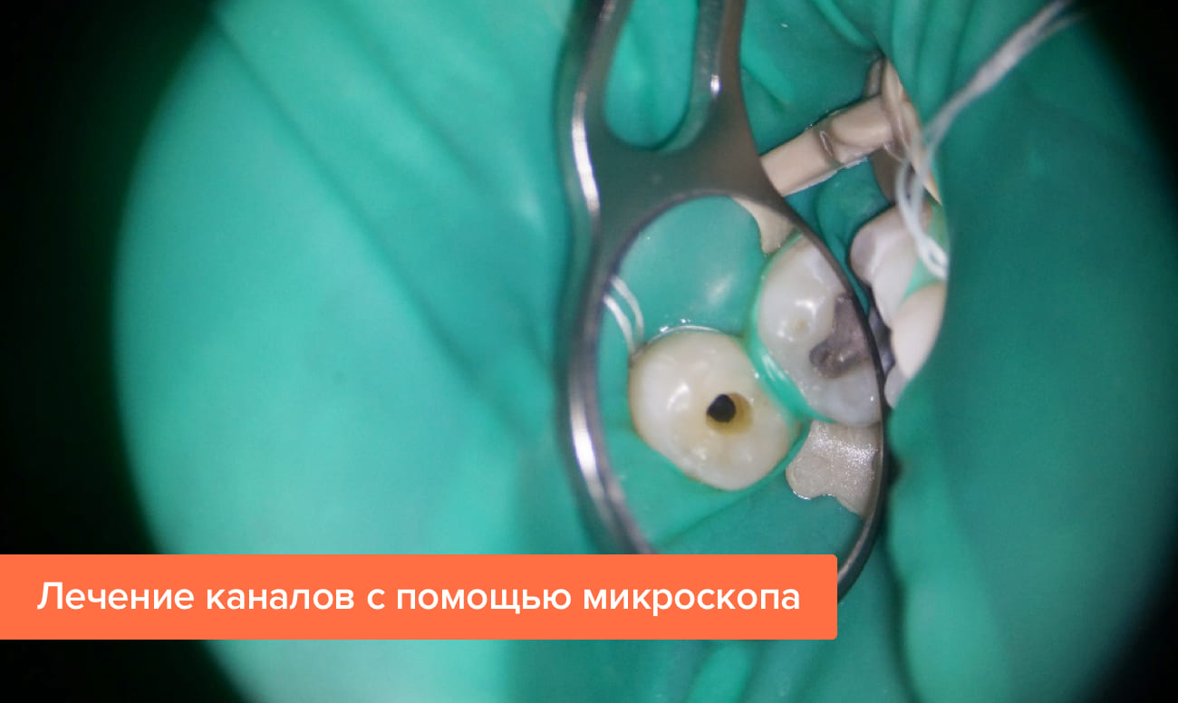 Лечение каналов с помощью микроскопа через микродоступ Фото лечения каналов с помощью микроскопа через микродоступ