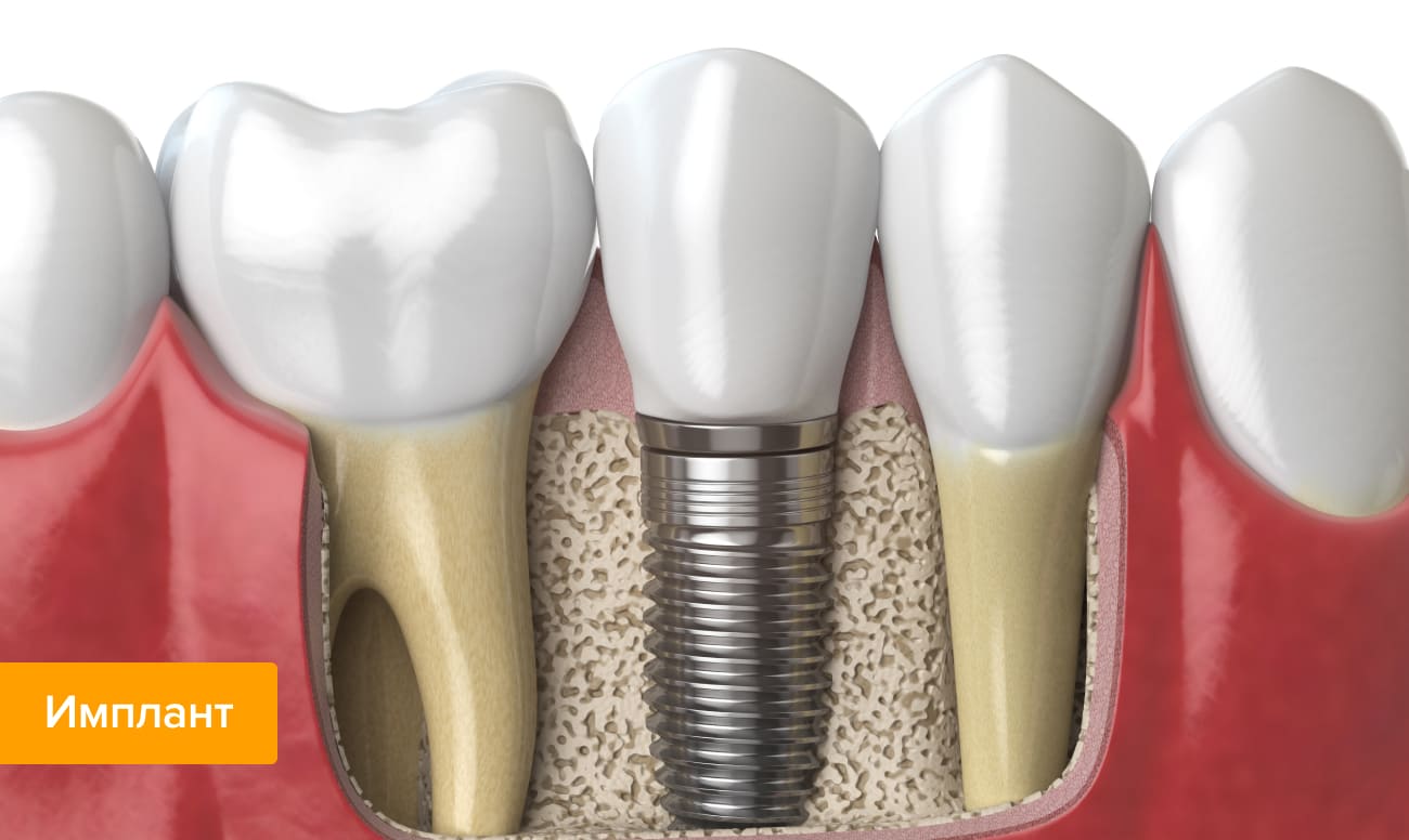 Имплант зуба в картинках