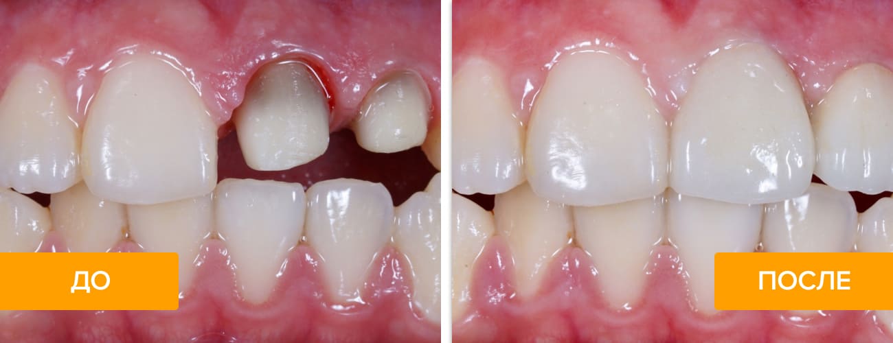 Фото пациента до и после установки цельнокерамических коронок