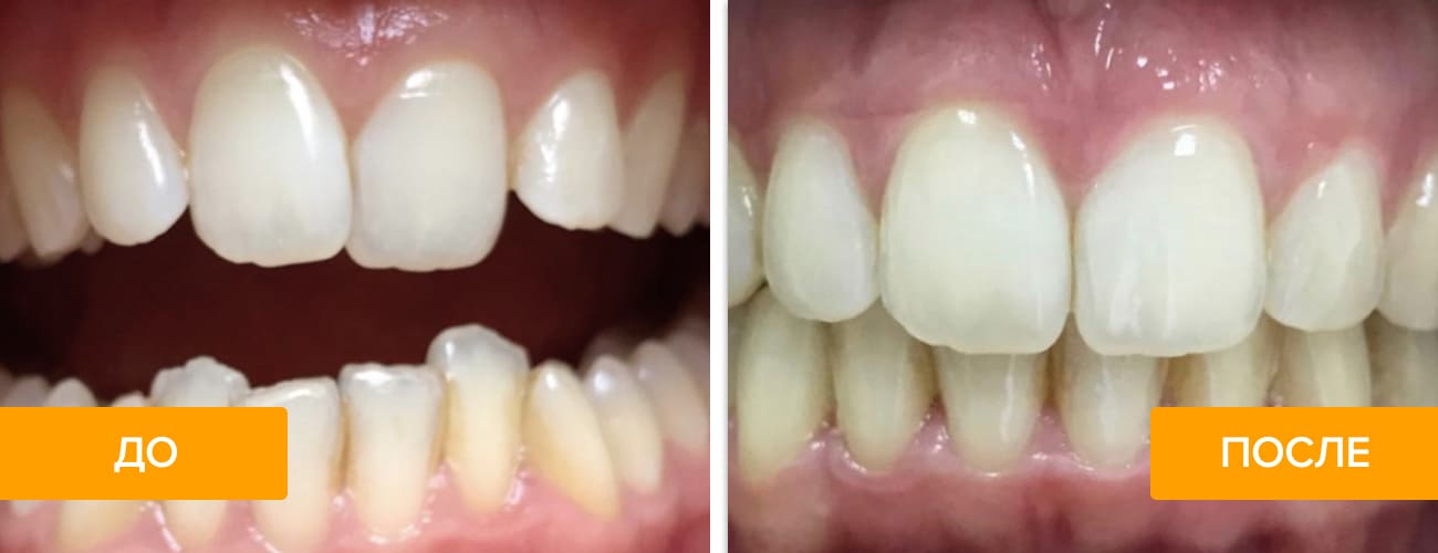 Фото зубов пациента до и после лечения элайнерами
