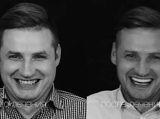 Улыбка от Ильи Склярова - виниры в SmileClinic